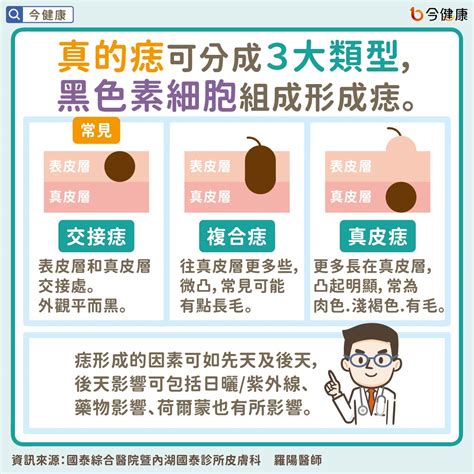 為甚麼會長痣|痣是什麼？一次了解痣原因、就醫時機以及如何改善